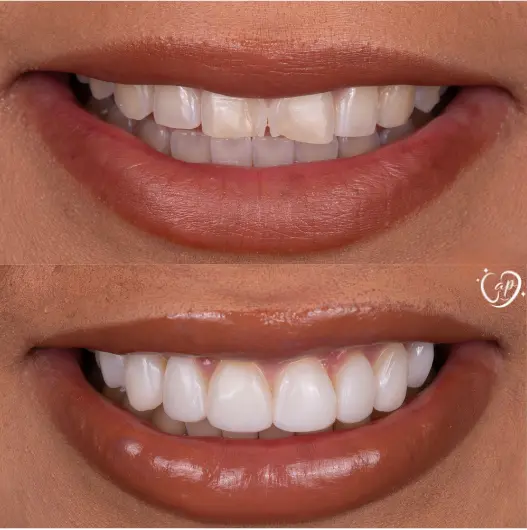 Porcelain bridge dental work at CaP Dental Clinic Vapi