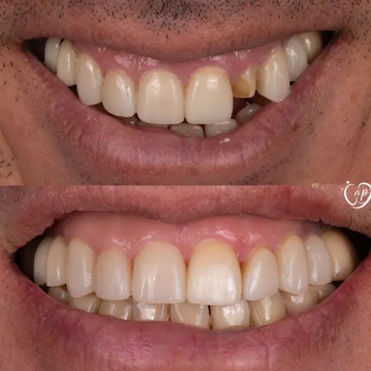 Before and after dental transformation results