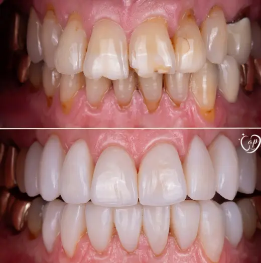 Dental restoration work by Dr. Sonia Bansal